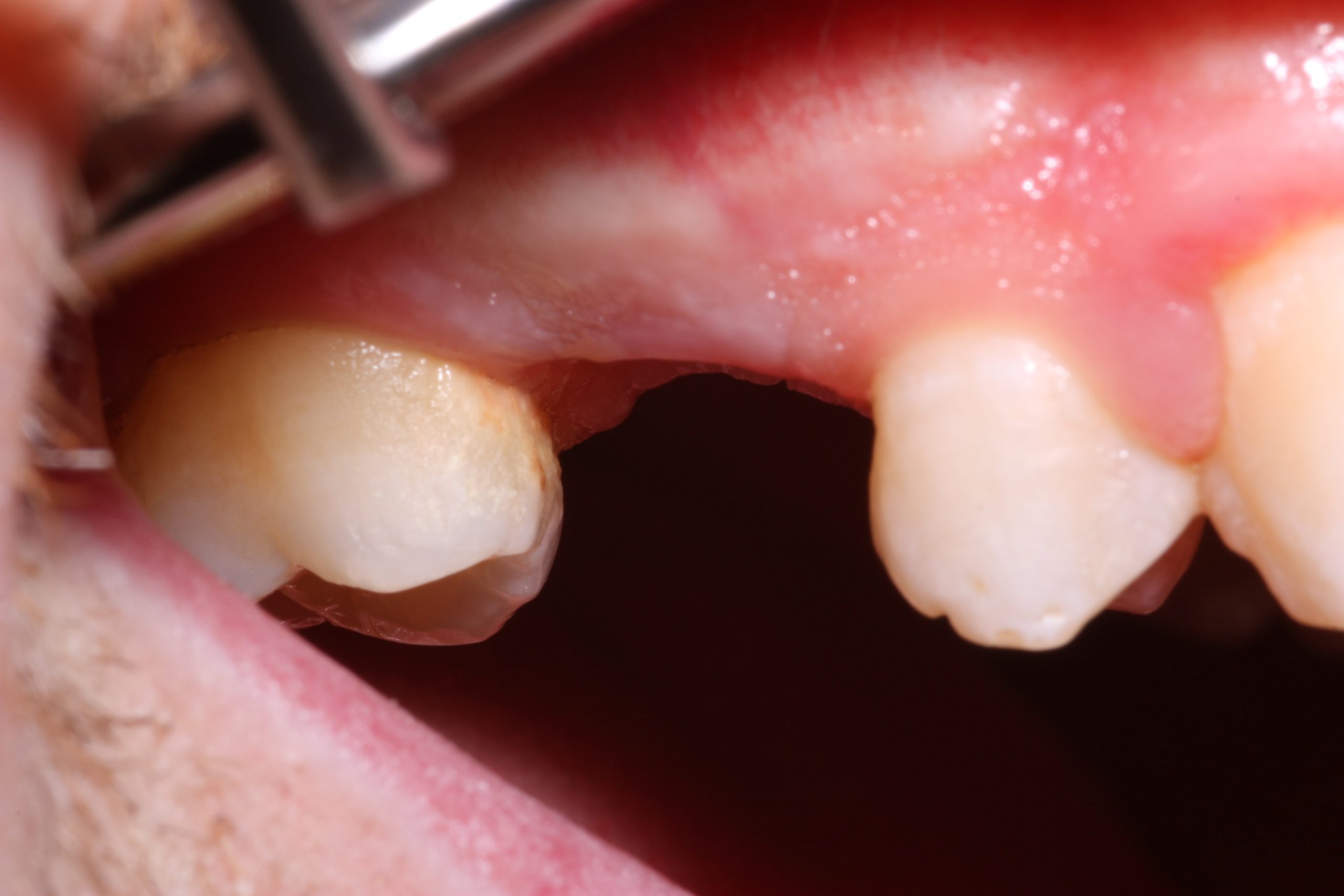 B1 Missing pre molar case study_beechwood dental