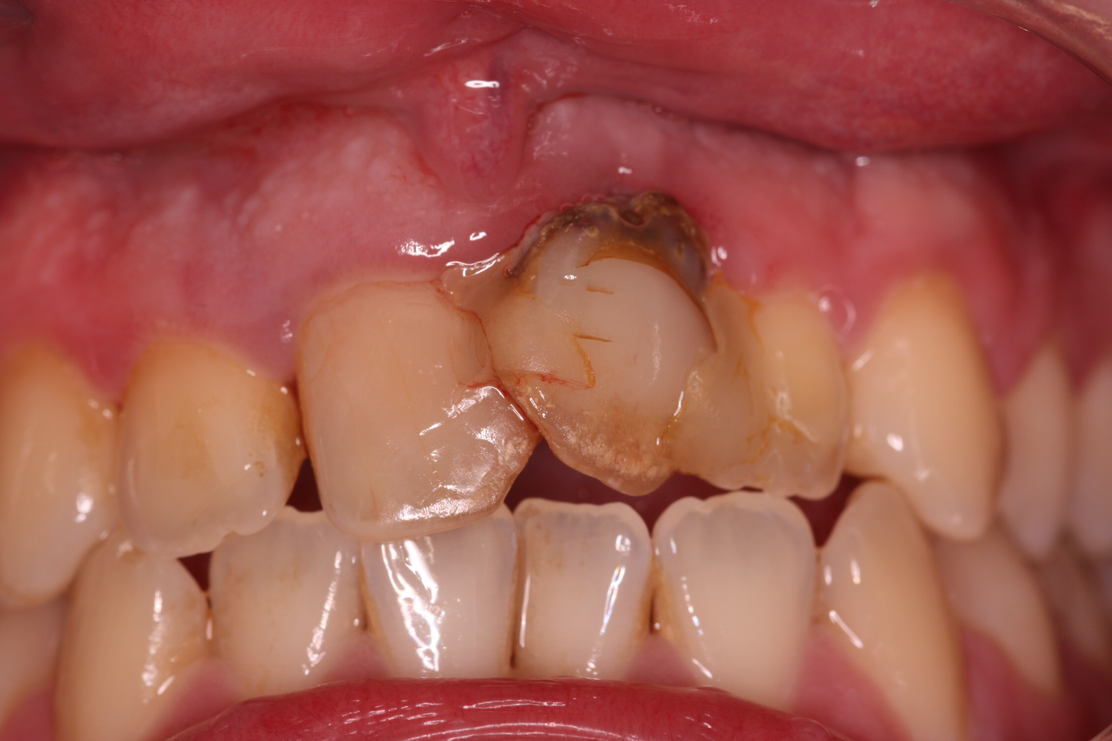 C1 Upper front teeth case_beechwood dental