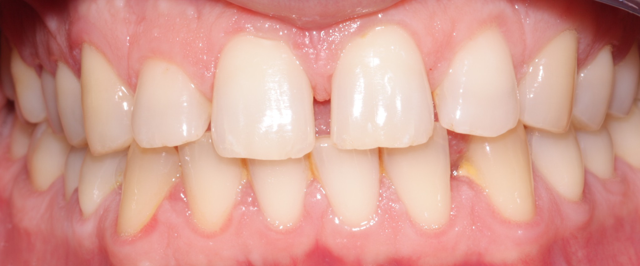 G1 Before Beechwood Dental_best dentist dublin